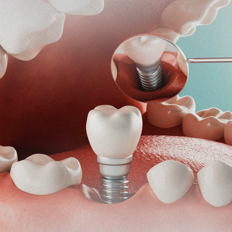 Implantes modernos: veja vantagens